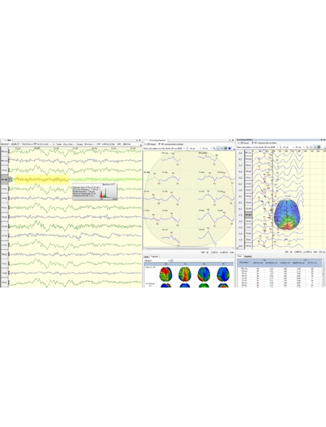 Sistema de EEG/LTM/EP/PSG Digital de 39 Canales Neuron-Spectrum-65